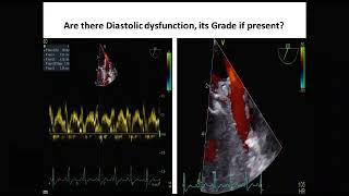 Traces-3  TEE   Diastolic Dysfunction by PV flow