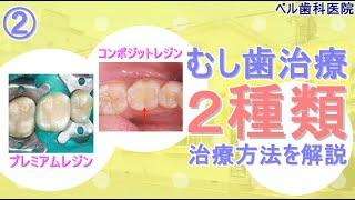【歯の解説】失敗しないむし歯治療【直接法】