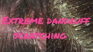 EXTREME DANDRUFF | SCRATCHING MY SCALP | SATISFYING DANDRUFF PICKING