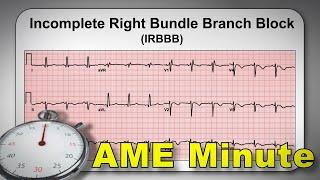 AME Minute: Why is an Incomplete Right Bundle Branch Block considered a normal variant?