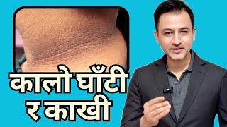 Dark Underarm, Neck, Back, Elbows and knees, Thighs, Lips | How to treat