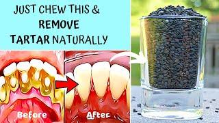 ️ 5 Natural Ways to Remove Tartar Buildup & Plaque on the teeth