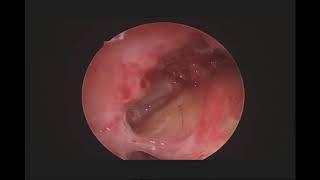 post operative endoscopic view of sinuses