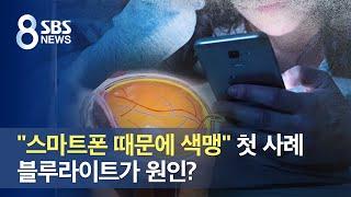 "스마트폰 때문에 색맹" 첫 사례…블루라이트가 원인? / SBS