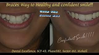 Braces: way to achieve Helathy and Confident smile