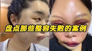 搞笑合集: 那些整容失败案例，小伙子一夜之间老了二十岁，悔不当初