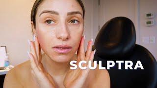 SCULPTRA TREATMENT | What is it? What does it do? Does it actually work?