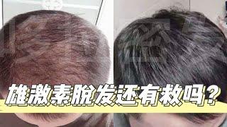 雄激素脱发还有救吗？？？