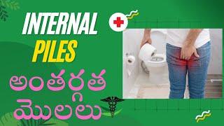 Internal piles | అంతర్గత మొలలు