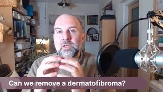 #AskJJ Can we remove a dermatofibroma?