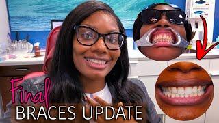 Final Braces Update | Permanent Retainer + Cleaning + Teeth Whitening? | Starring Shameka