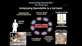 Ankylosing Spondylitis An Overview - Everything You Need To Know - Dr. Nabil Ebraheim