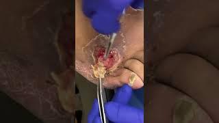 Debriding Diabetic Ulcers: A Critical Step in Wound Healing