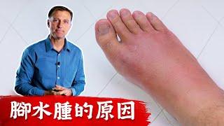 腳水腫的原因,不要掩蓋症狀!!柏格醫生 Dr Berg