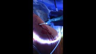 Preparing the footprint for a rotator cuff tear #shorts