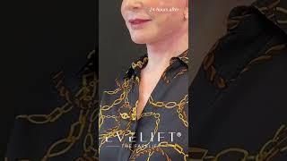 Beautiful Neckline After EVE Lift™ | Eden Plastic Surgery: Dr. Ali Charafeddine, MD