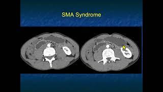 CT of the Abdominal Aorta and Its Branches: Aneurysms, Dissections and Vasculitis - Part 1