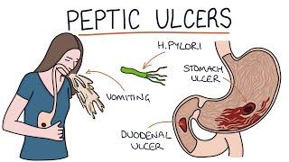 Understanding Stomach and Duodenal Ulcers