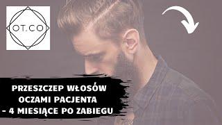 Przeszczep Włosów oczami pacjenta - OT.CO Clinic