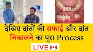 देखिए दांतों की सफाई और दांत निकालने का पूरा Process ( LIVE ) | Seraphic Dental | Indore