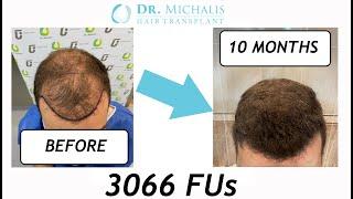 FUE Hair Transplant Progress 1- 10 months Before After | Concentration front baldness—Dr. Michalis