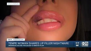 ‘The bruising is crazy’: Arizona woman shares lip filler nightmare