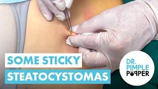 SATISFYING STICKY STEATOCYSTOMAS