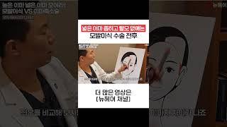 남자 엠자탈모 여자 넓은이마 6cm까지 좁히기 가능