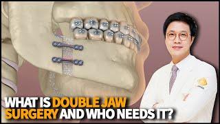 What is Double Jaw Surgery, how it works and who needs this cosmetic procedure?