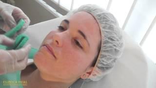 PEELING FACIAL PARA ACNÉ, MANCHAS Y ARRUGAS FACIALES EN VALENCIA