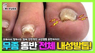무좀을 동반한 열발톱 모두 내성발톱?! 움푹 파인 엄지 내성발톱 관리하기!! #레푸스 #레푸스일산 #내성발톱 #내성발톱제거영상 #무좀발톱