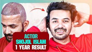 Actor Shojol Islam's Hair Transplant (Amazing Results)  | Bangladesh | New Roots