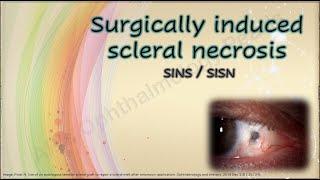 Surgically induced scleral necrosis | Mini review series 1