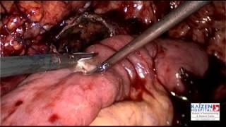 LAPAROSCOPIC CYSTOJEJUNOSTOMY - KAIZEN HOSPITAL AHMEDABAD