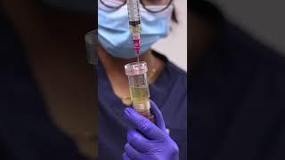 #Vcare launches New Era of Hair Restoration - EXOGRO Technology