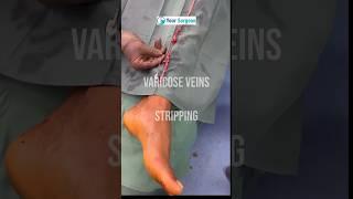 Recurrent Varicose veins ulcer treatment in Surat