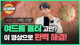 여드름 패인 흉터도 없앨 수 있을까?｜의사가 다 알려줍니다!