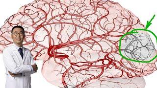 脑梗塞，哪些疾病可以导致？医生说：3种不同病因，治疗方法不同