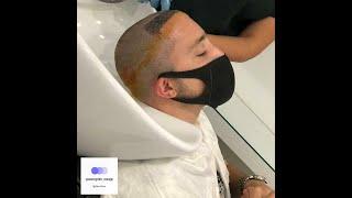 My Hair Transplant Process - CRAZY PRESENTATION 5 ANGELS-First 4 Months-Dr Ilker Apaydin 2334 Grafts