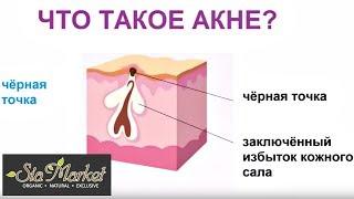 Что такое Акне? / Причины, Симптомы