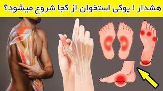 علائم اولیه پوکی استخوان وعلل  از کجا شروع میشود! Osteoporosis Causes & Symptoms and Signs