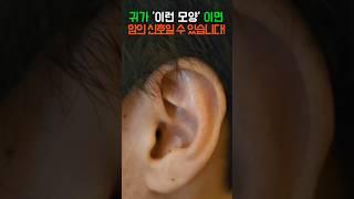 귀가 '이 모양' 이라면, 암의 신호일 수 있습니다! #건강 #건강정보 #귀 #암 #피부암 #림프종 #암증상