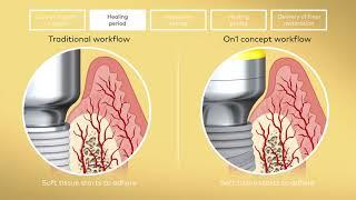 On1™ concept   Nobel Biocare