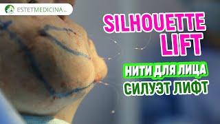 Установка нитей Силуэт Лифт   Silhouette Lift ️  НИТИ ДЛЯ ПОДТЯЖКИ ЛИЦА