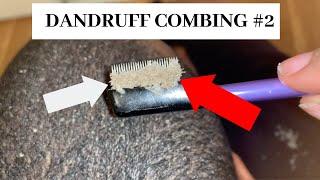 Dandruff combing #2