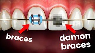 Traditional Braces vs Damon Braces...which is better?