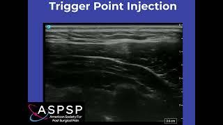 Ultrasound Guided Trigger Point Injections