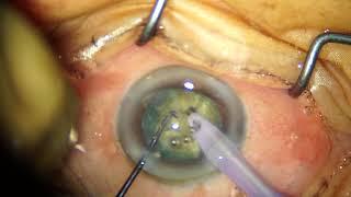 Phaco in Grade 5 Cataract with the Laureate: My preferred settings