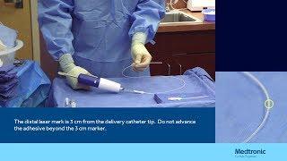 Treatment for varicose veins | VenaSeal Closure System | Medtronic India