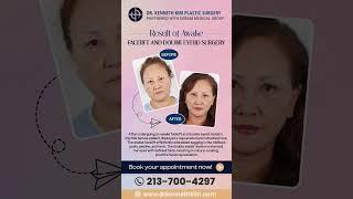 Awake Facelift & Double Eyelid Surgery: Transform Your Beauty with Dr. Kenneth Kim